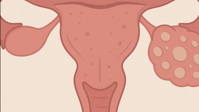 PCOS