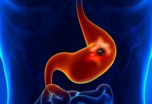 Peptic ulcer