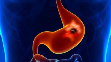 Peptic ulcer