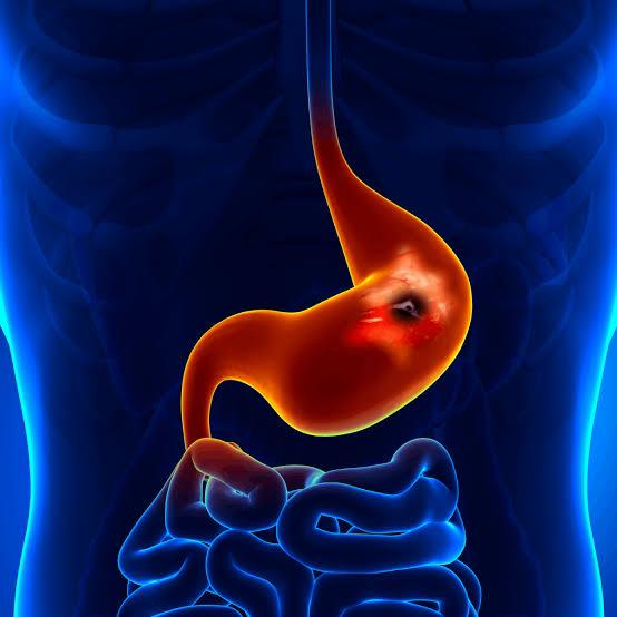 Peptic ulcer