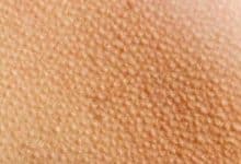 goosebumps dry 1