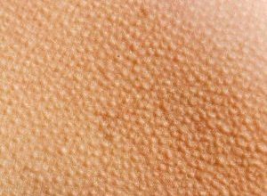 goosebumps dry 1