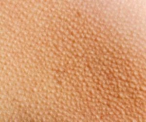 جلد الوزة انواعة وطرق علاجها نهائيا 1 goosebumps dry 1