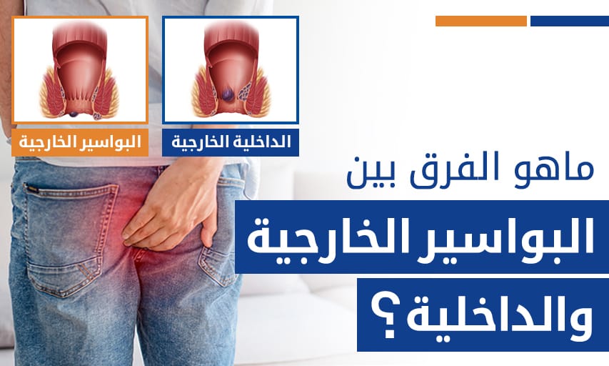 البواسير والناسور الفرق بينهم وافضل طرق العناية بيهم hemorroides