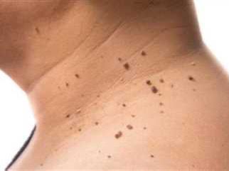 مقاومة الأنسولين أسبابها وطرق العلاج والمحافظة 1 insulinresistance