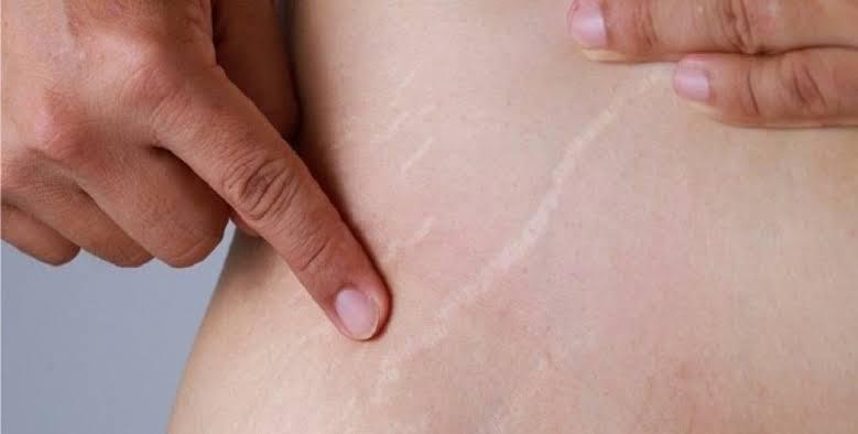 علاج خطوط التمدد البيضاء والحمراء والوقاية منها 1 white Marks