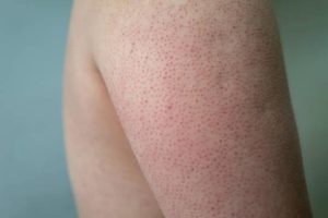 جلد الوزة انواعة وطرق علاجها نهائيا 2 Strawberry Skin