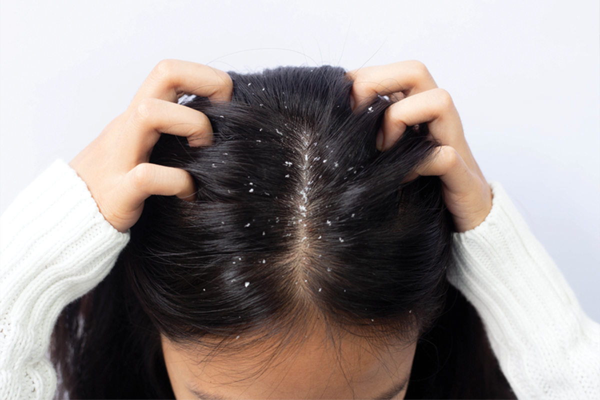 علاج القشرة الجافة drydandruff